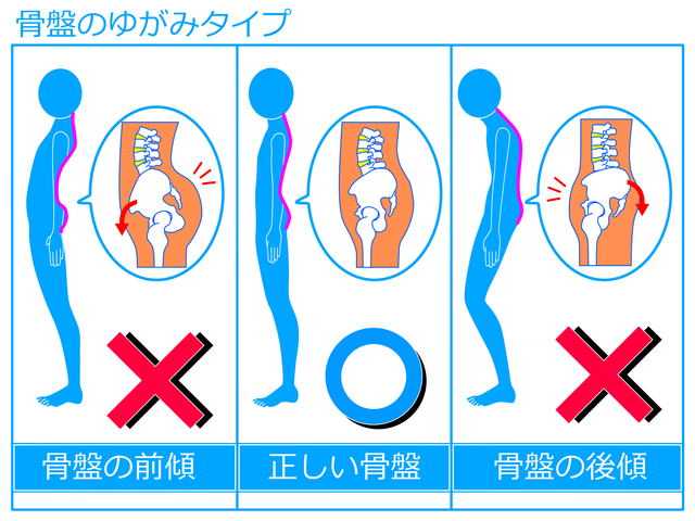 骨盤の歪みタイプ